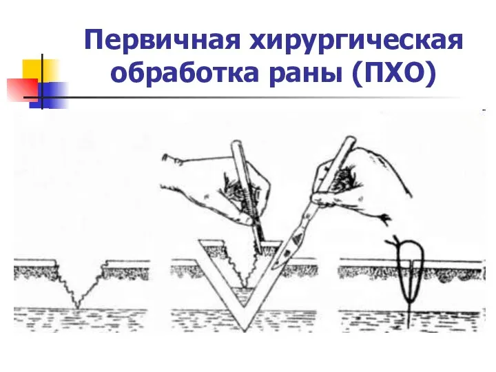 Первичная хирургическая обработка раны (ПХО)