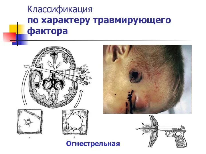 Классификация по характеру травмирующего фактора Огнестрельная