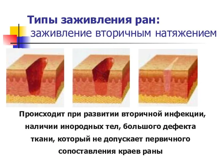 Типы заживления ран: заживление вторичным натяжением Происходит при развитии вторичной инфекции,