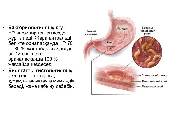 Бактериологиялық егу – НР инфицирленген кезде жүргізіледі. Жара антральді бөлікте орналасқанда