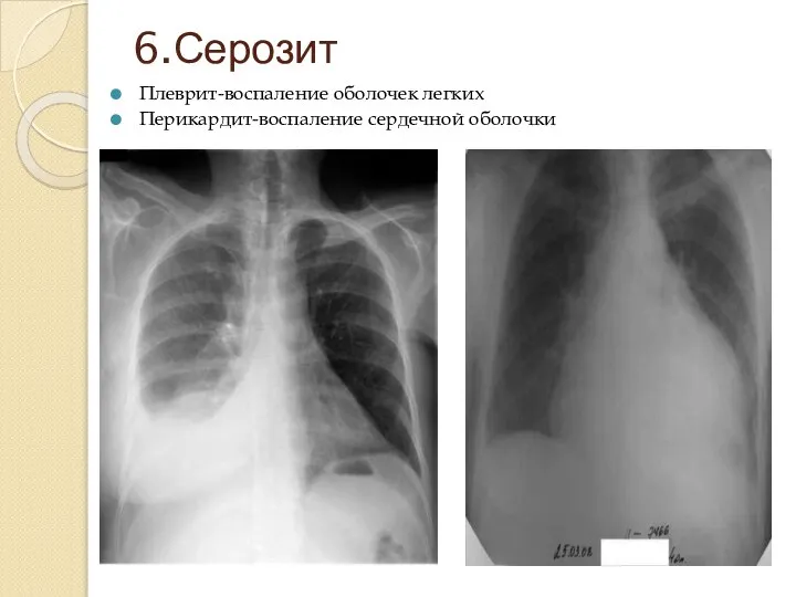 6.Серозит Плеврит-воспаление оболочек легких Перикардит-воспаление сердечной оболочки