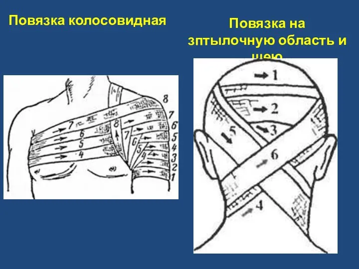 Повязка колосовидная Повязка на зптылочную область и шею