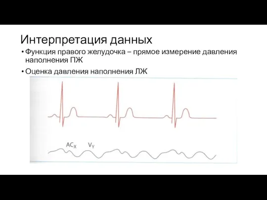 Интерпретация данных Функция правого желудочка – прямое измерение давления наполнения ПЖ Оценка давления наполнения ЛЖ