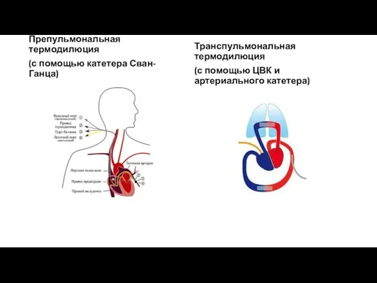 Препульмональная термодилюция (с помощью катетера Сван-Ганца) Транспульмональная термодилюция (с помощью ЦВК и артериального катетера)