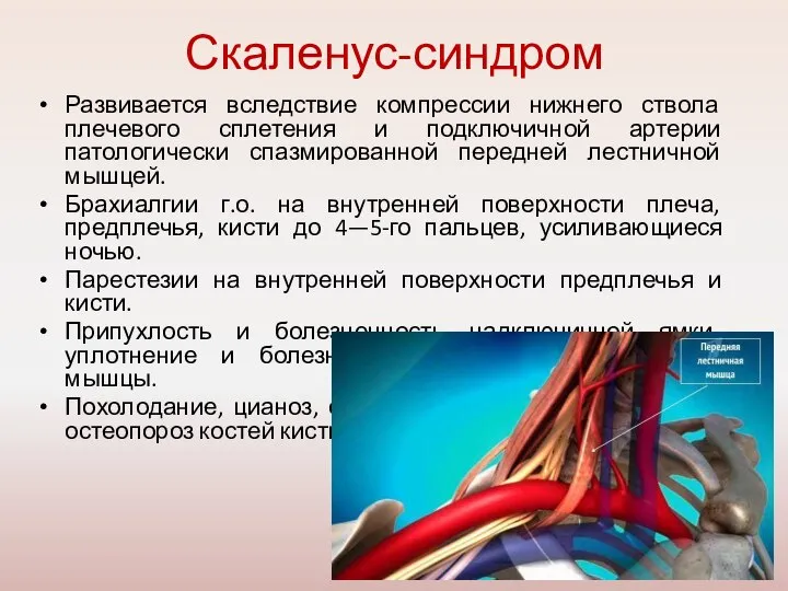 Скаленус-синдром Развивается вследствие компрессии нижнего ствола плечевого сплетения и подключичной артерии