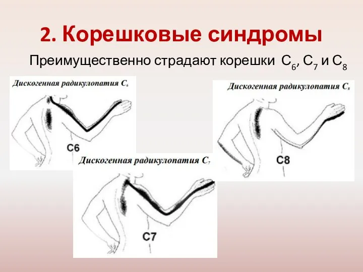 2. Корешковые синдромы Преимущественно страдают корешки С6, С7 и С8