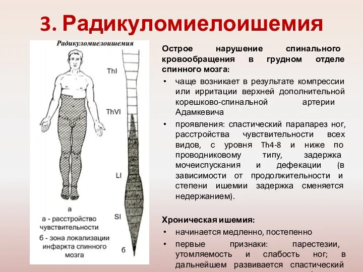 3. Радикуломиелоишемия Острое нарушение спинального кровообращения в грудном отделе спинного мозга: