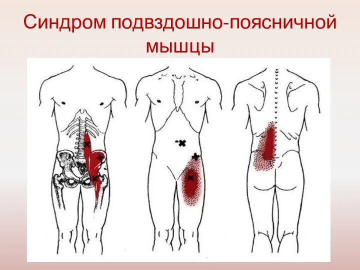 Синдром подвздошно-поясничной мышцы