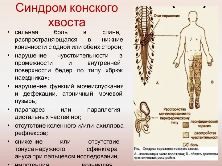 Синдром конского хвоста сильная боль в спине, распространяющаяся в нижние конечности