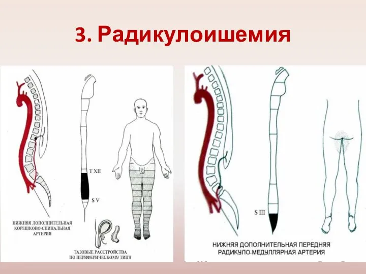 3. Радикулоишемия