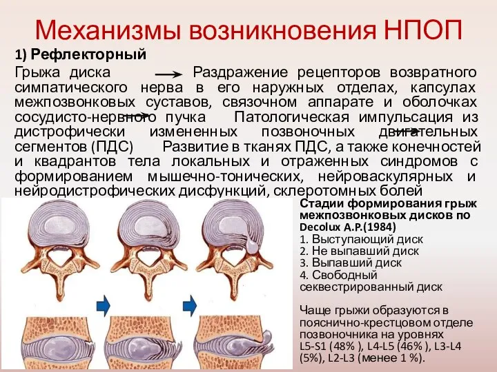 Механизмы возникновения НПОП 1) Рефлекторный Грыжа диска Раздражение рецепторов возвратного симпатического