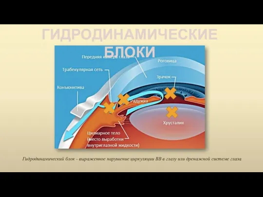 ГИДРОДИНАМИЧЕСКИЕ БЛОКИ Гидродинамический блок - выраженное нарушение циркуляции ВВ в глазу или дренажной системе глаза