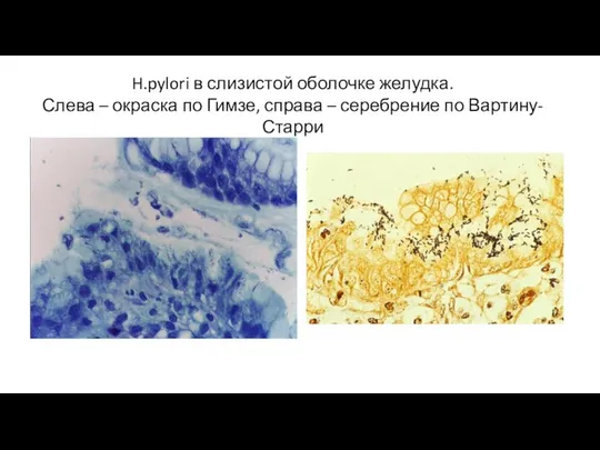 H.pylori в слизистой оболочке желудка. Слева – окраска по Гимзе, справа – серебрение по Вартину-Старри