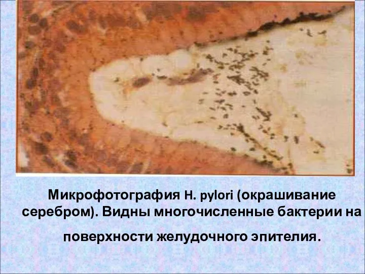 Микрофотография H. pylori (окрашивание серебром). Видны многочисленные бактерии на поверхности желудочного эпителия.