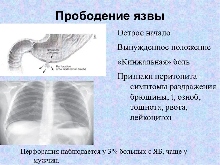 Перфорация наблюдается у 3% больных с ЯБ, чаще у мужчин. Прободение