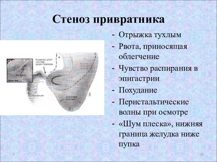 Стеноз привратника Отрыжка тухлым Рвота, приносящая облегчение Чувство распирания в эпигастрии