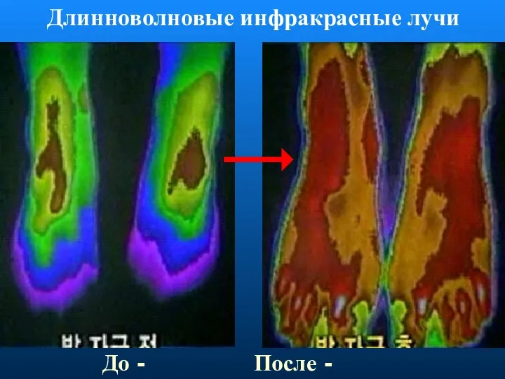 Длинноволновые инфракрасные лучи До - После -