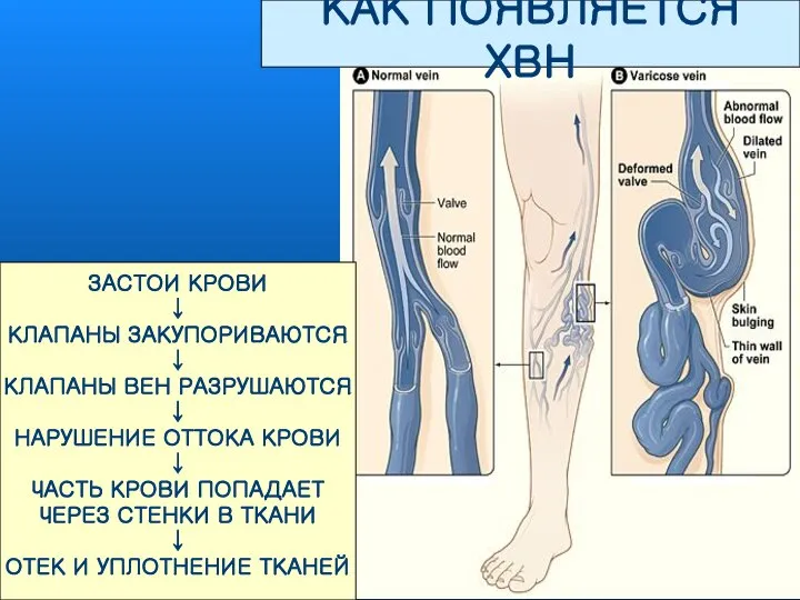 КАК ПОЯВЛЯЕТСЯ ХВН ЗАСТОИ КРОВИ ↓ КЛАПАНЫ ЗАКУПОРИВАЮТСЯ ↓ КЛАПАНЫ ВЕН