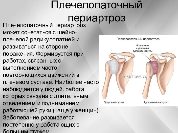 Плечелопаточный периартроз Плечелопаточный периартроз может сочетаться с шейно-плечевой радикулопатией и развиваться