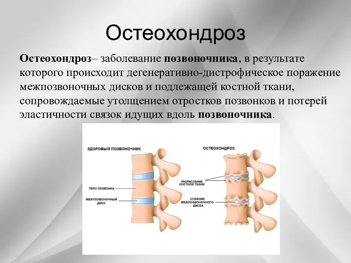 Остеохондроз Остеохондроз– заболевание позвоночника, в результате которого происходит дегенеративно-дистрофическое поражение межпозвоночных