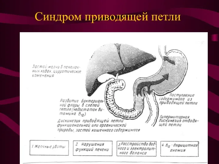 Синдром приводящей петли