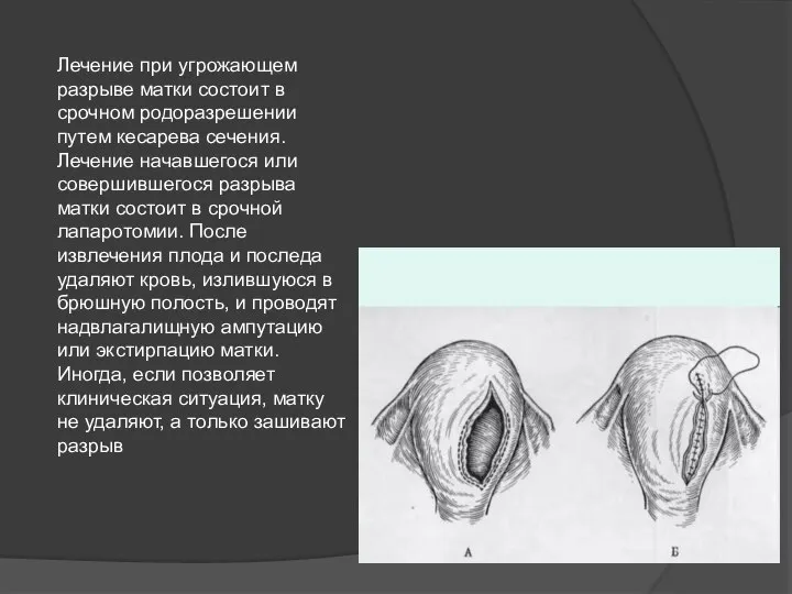 Лечение при угрожающем разрыве матки состоит в срочном родоразрешении путем кесарева