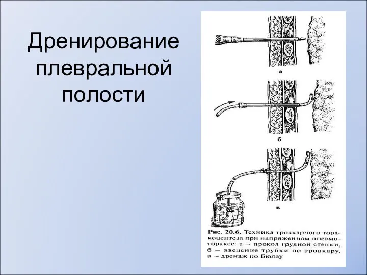 Дренирование плевральной полости