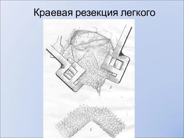 Краевая резекция легкого