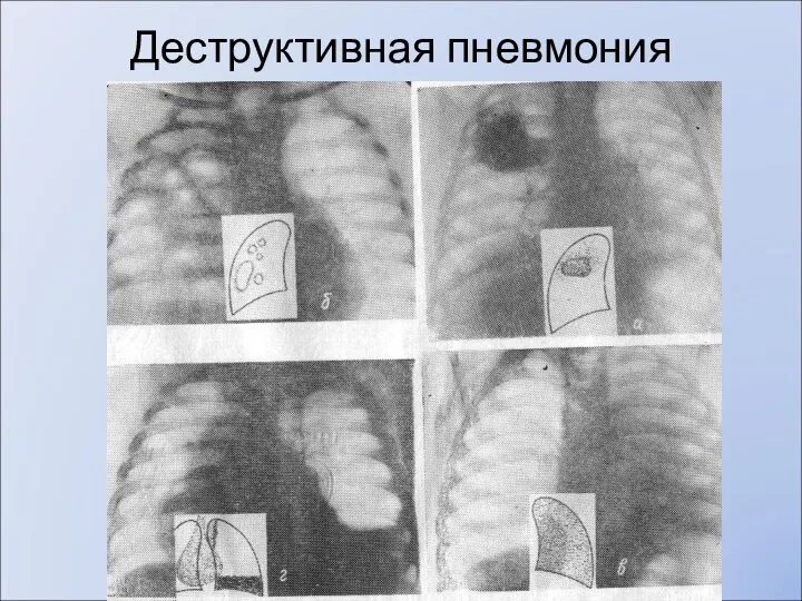 Деструктивная пневмония