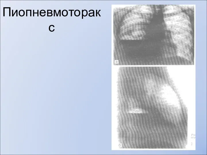 Пиопневмоторакс