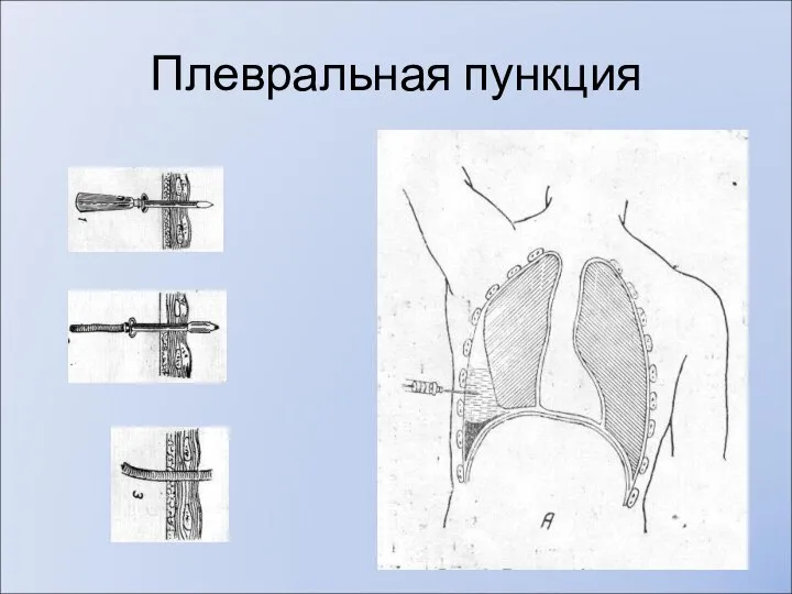 Плевральная пункция