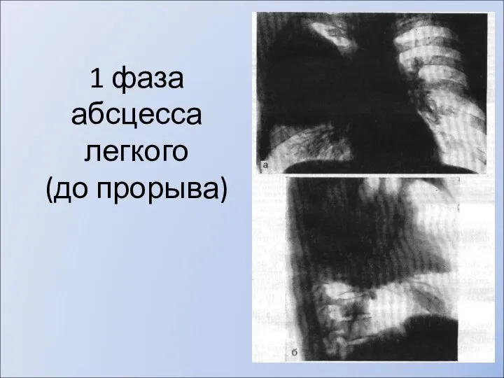 1 фаза абсцесса легкого (до прорыва)