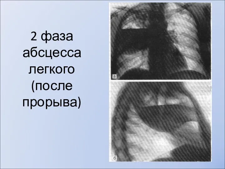 2 фаза абсцесса легкого (после прорыва)