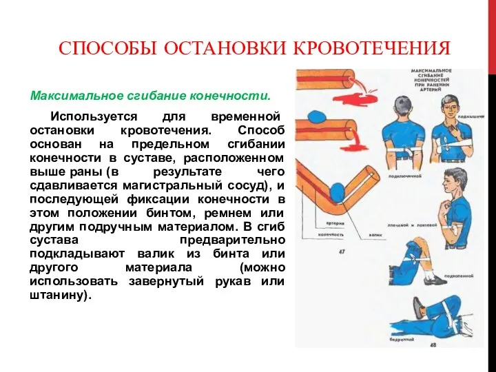 СПОСОБЫ ОСТАНОВКИ КРОВОТЕЧЕНИЯ Максимальное сгибание конечности. Используется для временной остановки кровотечения.