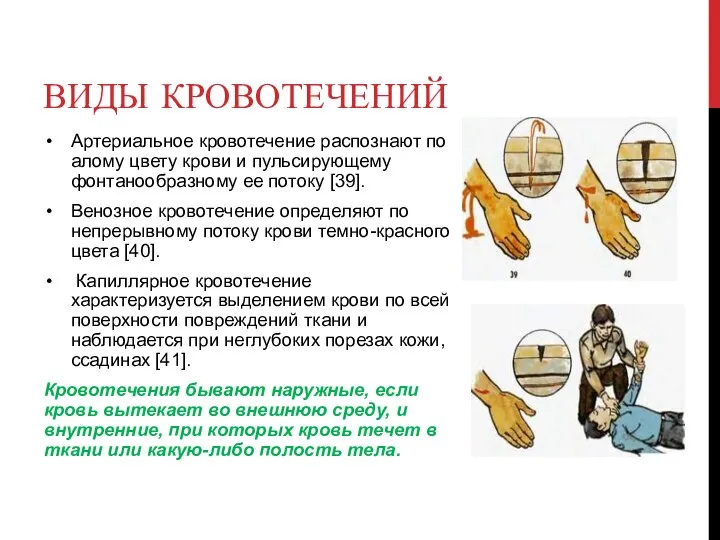 ВИДЫ КРОВОТЕЧЕНИЙ Артериальное кровотечение распознают по алому цвету крови и пульсирующему