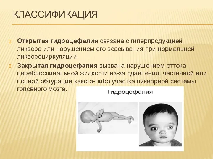 КЛАССИФИКАЦИЯ Открытая гидроцефалия связана с гиперпродукцией ликвора или нарушением его всасывания