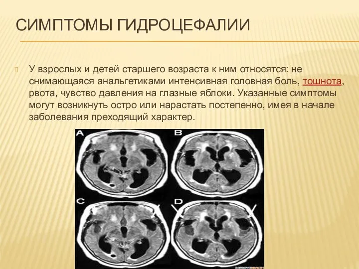 СИМПТОМЫ ГИДРОЦЕФАЛИИ У взрослых и детей старшего возраста к ним относятся: