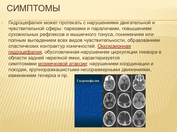 СИМПТОМЫ Гидроцефалия может протекать с нарушениями двигательной и чувствительной сферы: парезами