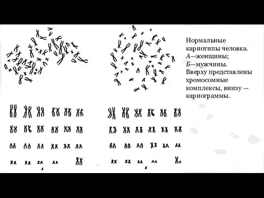 Нормальные кариотипы человка. А—женщины; Б—мужчины. Вверху представлены хромосомные комплексы, внизу — кариограммы.