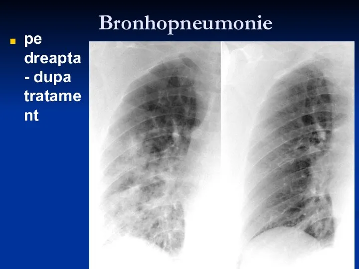 Bronhopneumonie pe dreapta - dupa tratament