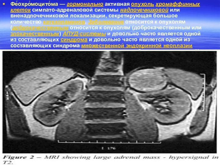 Фе́охро́моцито́ма — гормонально активная опухоль хромаффинных клеток симпато-адреналовой системы надпочечниковой или