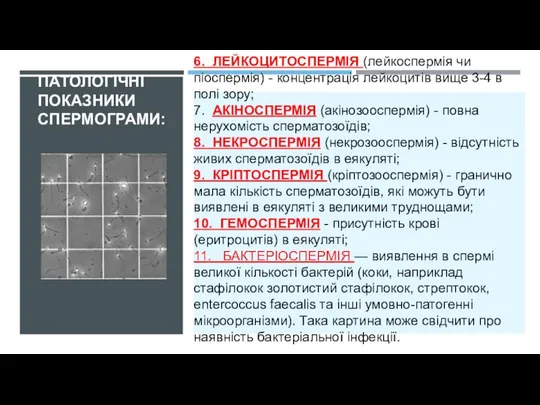 ПАТОЛОГІЧНІ ПОКАЗНИКИ СПЕРМОГРАМИ: 6. ЛЕЙКОЦИТОСПЕРМІЯ (лейкоспермія чи піоспермія) - концентрація лейкоцитів