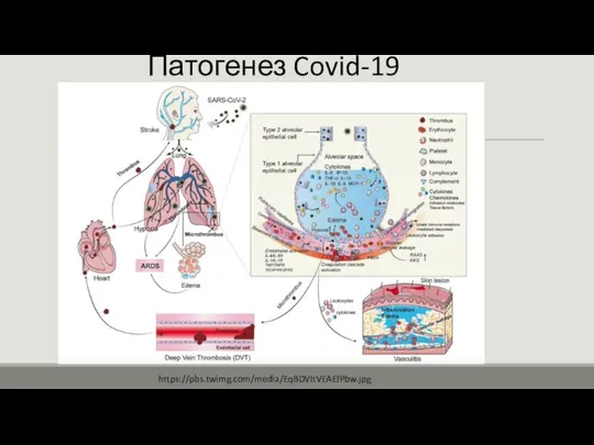 Патогенез Covid-19 https://pbs.twimg.com/media/EqBDVItVEAEfPbw.jpg