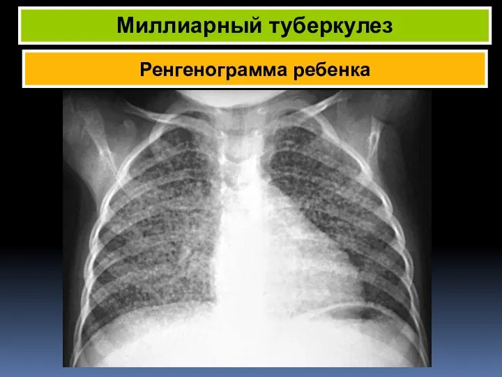 Ренгенограмма ребенка Миллиарный туберкулез