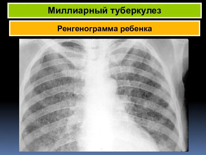 Ренгенограмма ребенка Миллиарный туберкулез