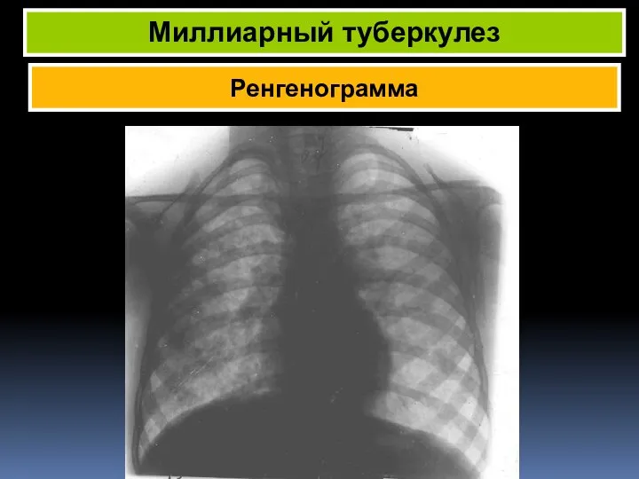 Ренгенограмма Миллиарный туберкулез