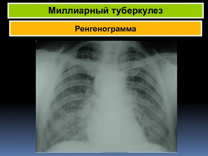 Ренгенограмма Миллиарный туберкулез