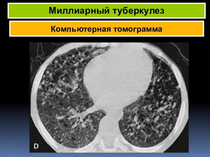 Компьютерная томограмма Миллиарный туберкулез