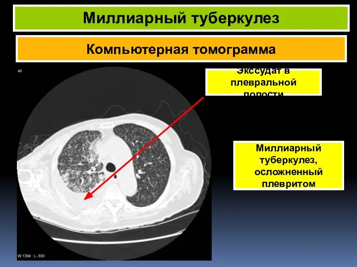 Компьютерная томограмма Миллиарный туберкулез Миллиарный туберкулез, осложненный плевритом Экссудат в плевральной полости