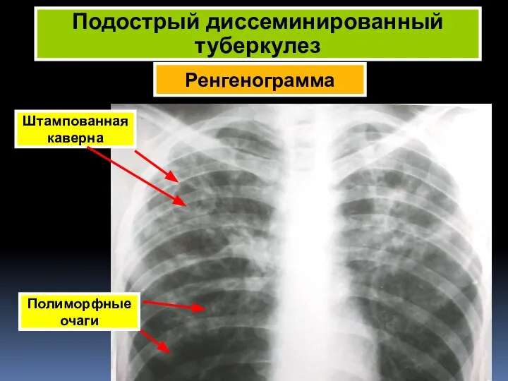 Ренгенограмма Подострый диссеминированный туберкулез Штампованная каверна Полиморфные очаги